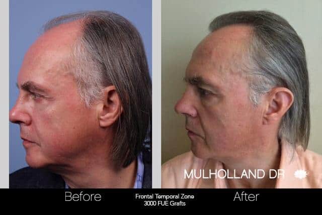 Artas Hair Transplant - Before and After Gallery - Patient Photo 44