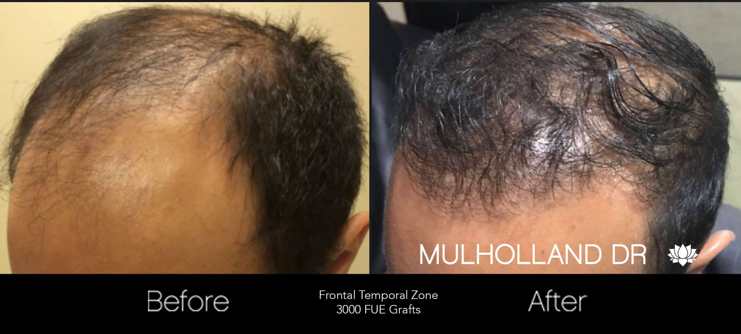 Artas Hair Transplant - Before and After Gallery - Patient Photo 45