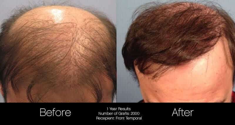 Artas Hair Transplant - Before and After Gallery - Patient Photo 46
