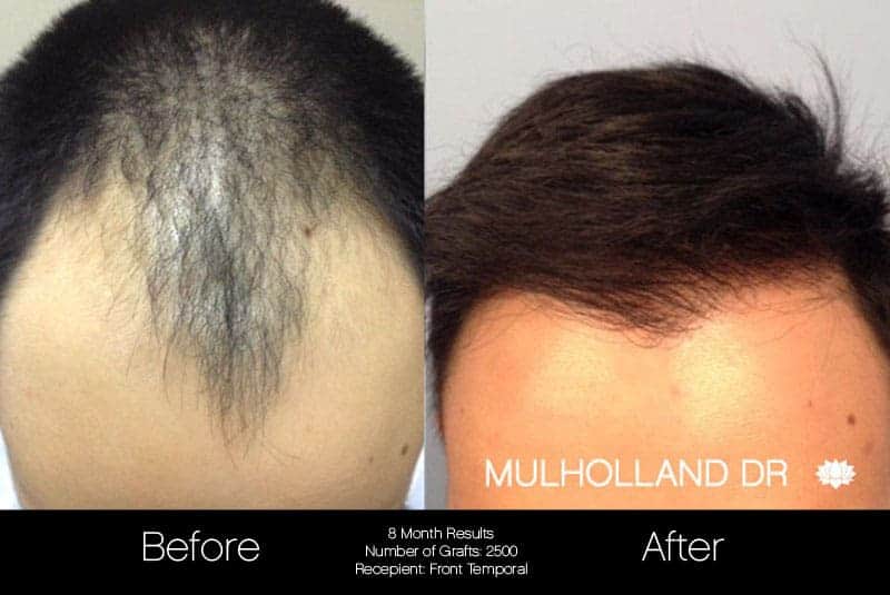 Artas Hair Transplant - Before and After Gallery - Patient Photo 47
