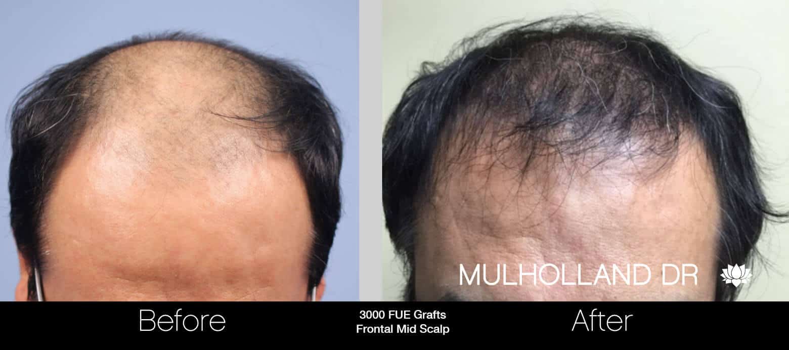 Artas Hair Transplant - Before and After Gallery - Patient Photo 48