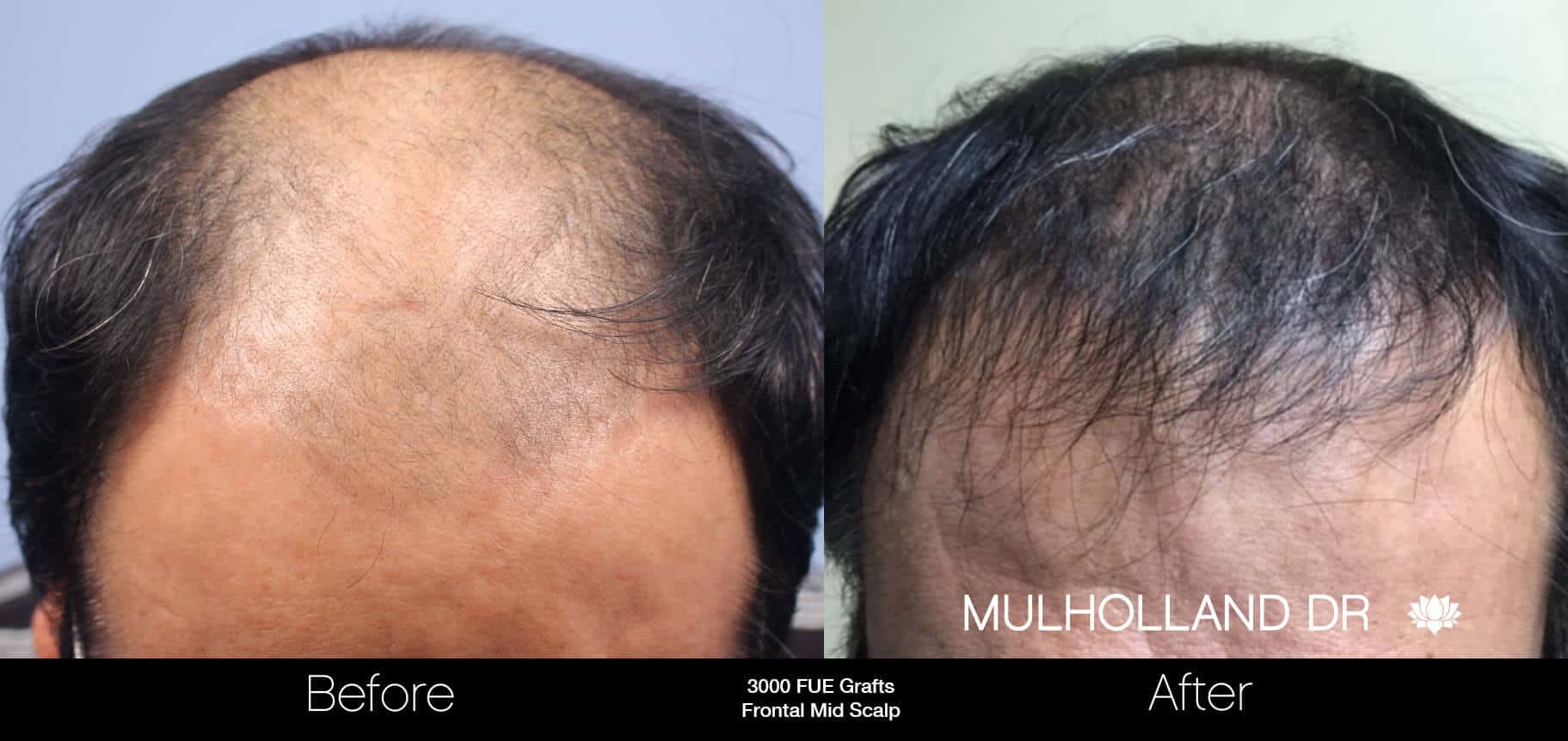 Artas Hair Transplant - Before and After Gallery - Patient Photo 49