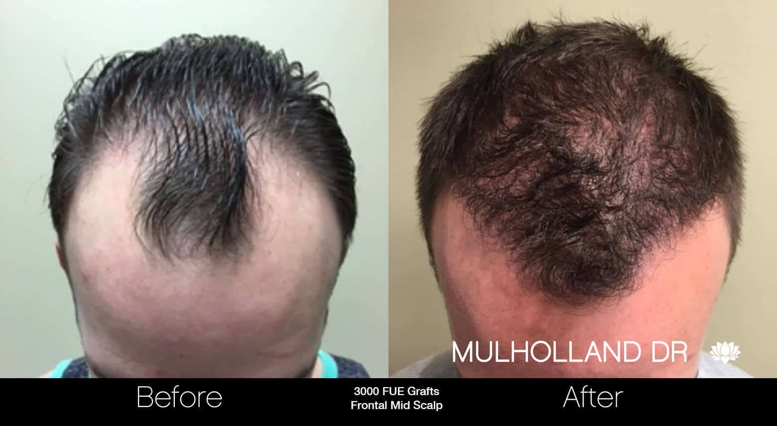 Artas Hair Transplant - Before and After Gallery - Patient Photo 5