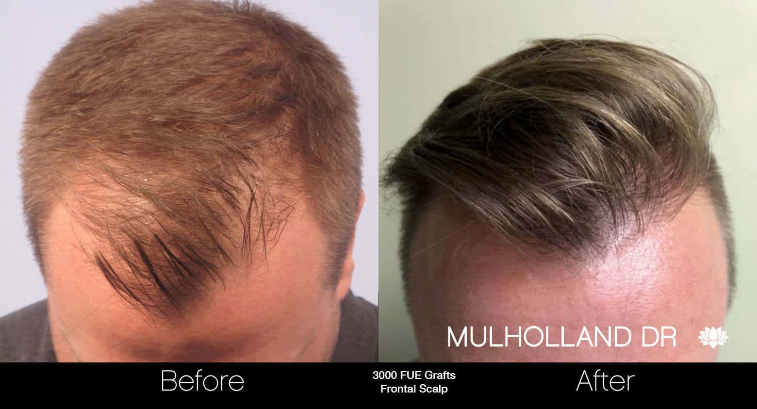 Artas Hair Transplant - Before and After Gallery - Patient Photo 50