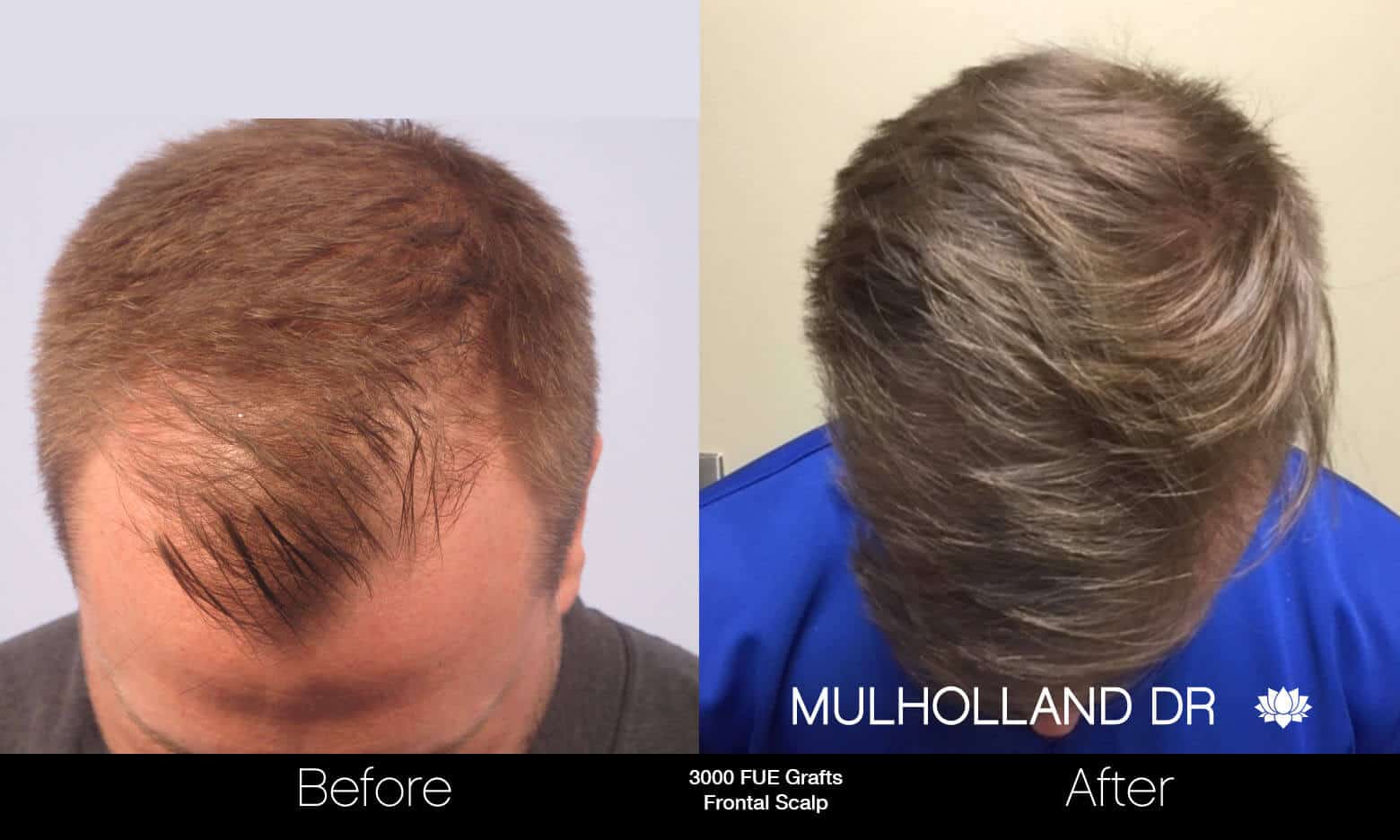 Artas Hair Transplant - Before and After Gallery - Patient Photo 52