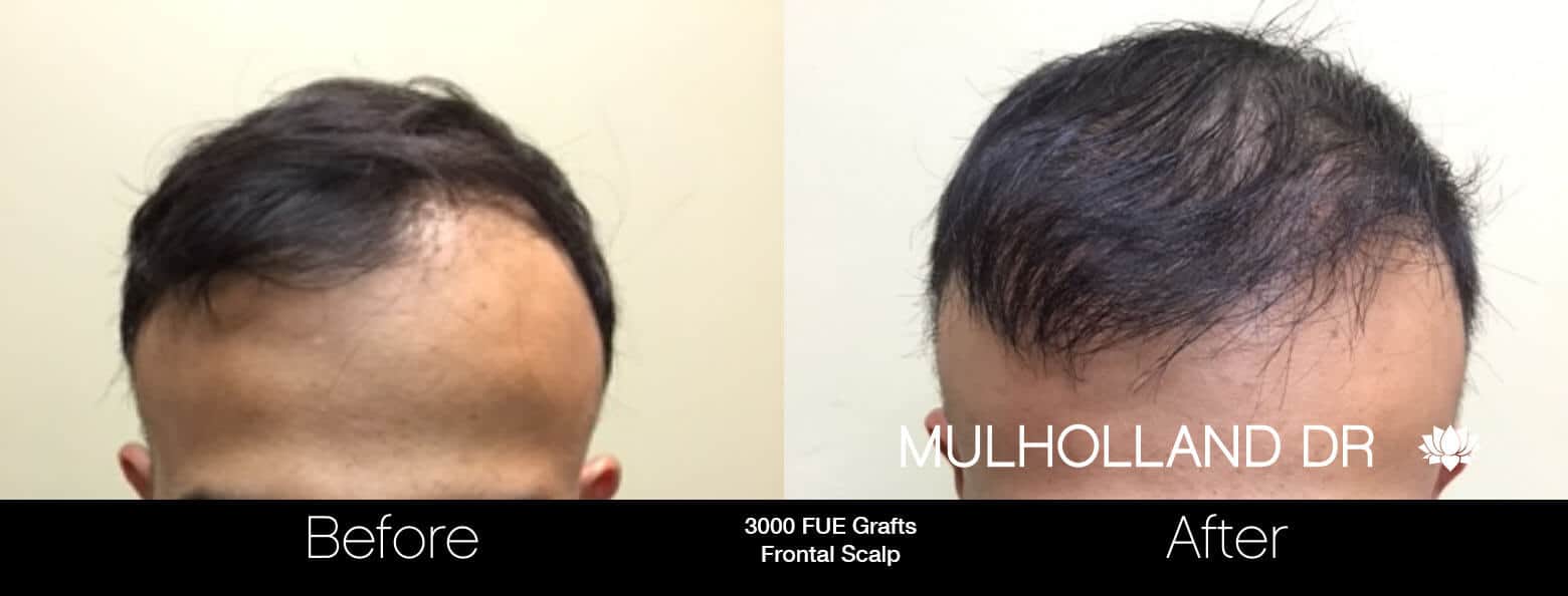 Artas Hair Transplant - Before and After Gallery - Patient Photo 53