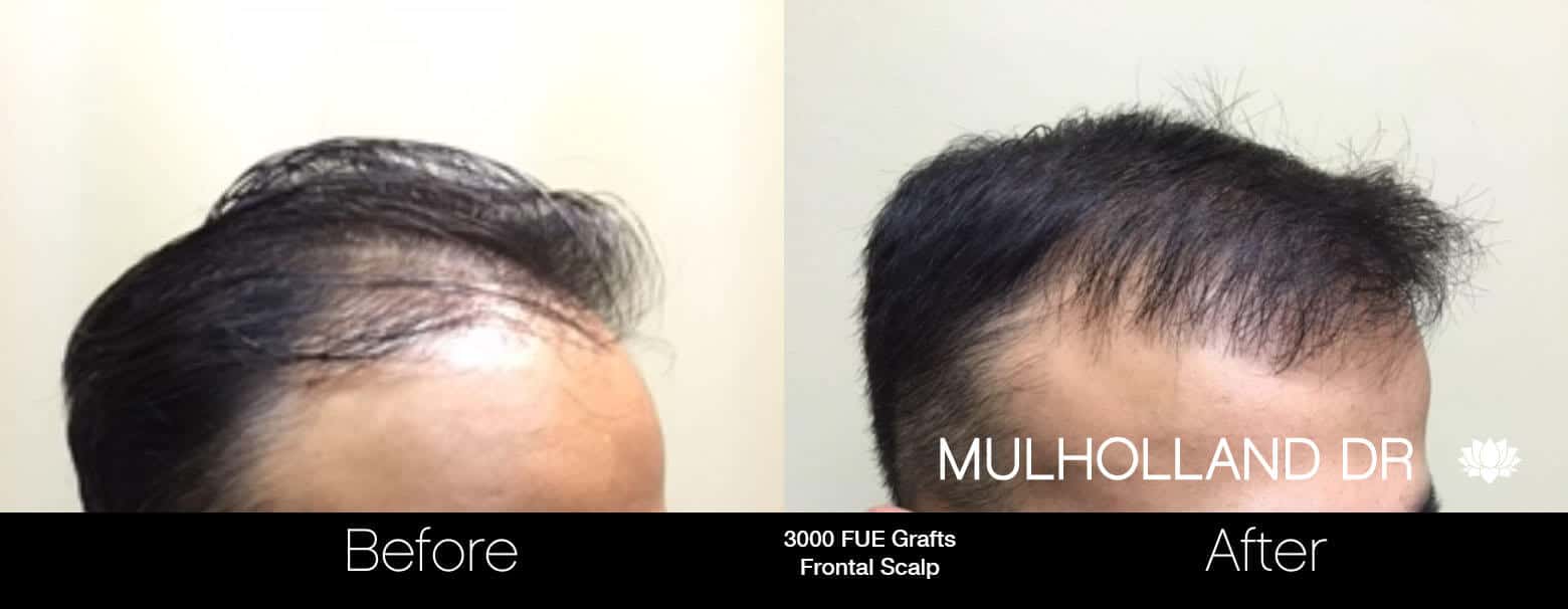 Artas Hair Transplant - Before and After Gallery - Patient Photo 55