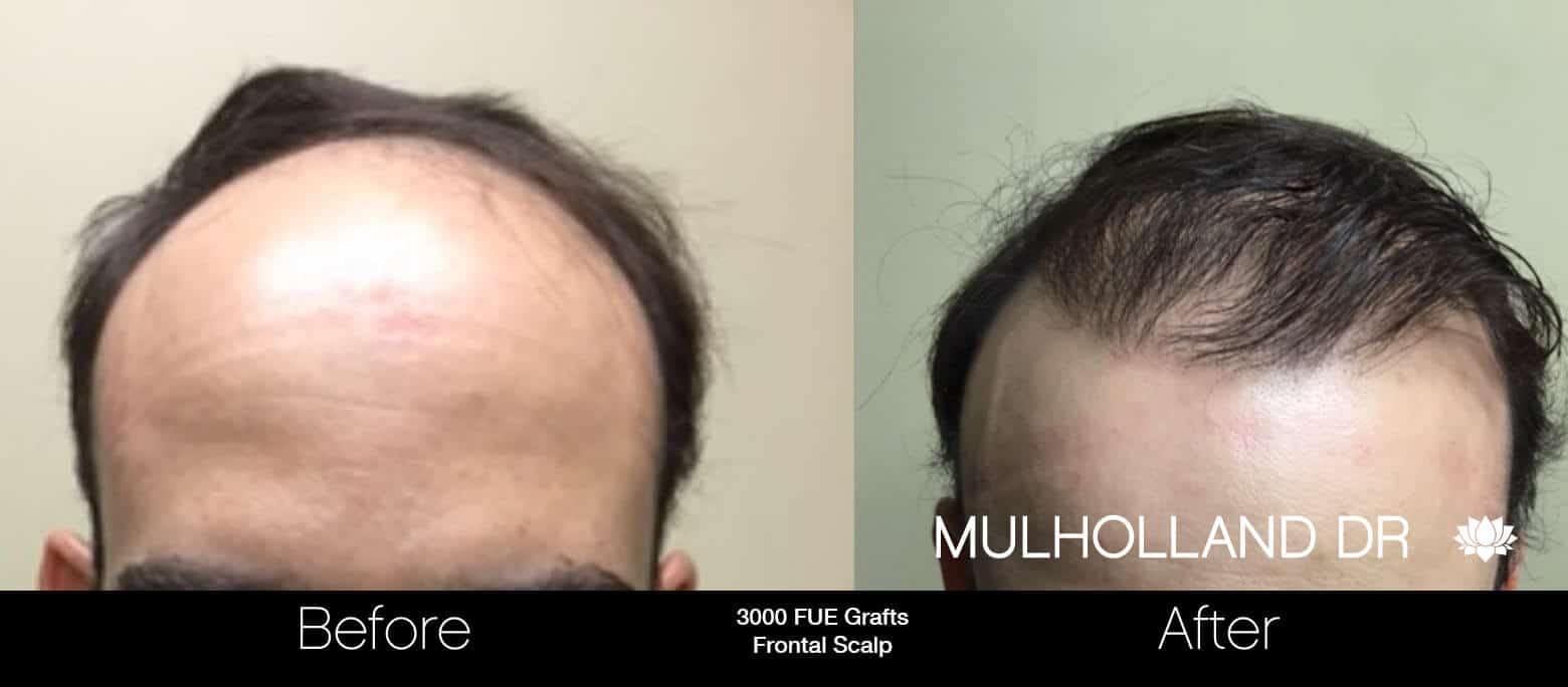 Artas Hair Transplant - Before and After Gallery - Patient Photo 56