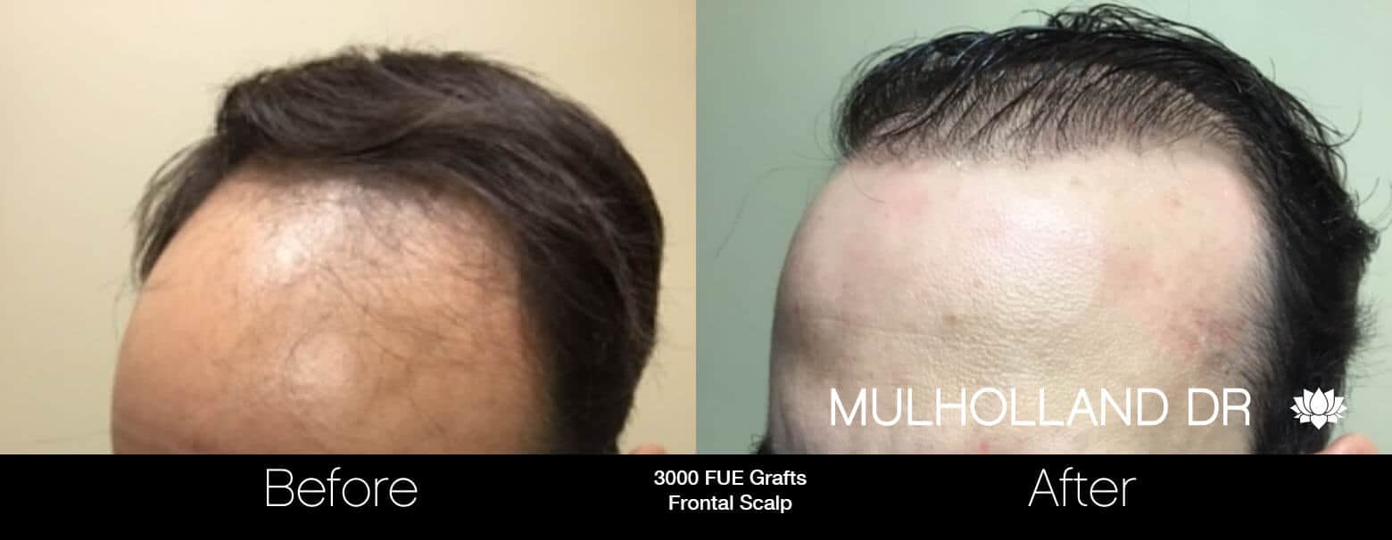 Artas Hair Transplant - Before and After Gallery - Patient Photo 57