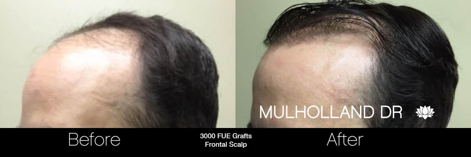 Artas Hair Transplant - Before and After Gallery - Patient Photo 58
