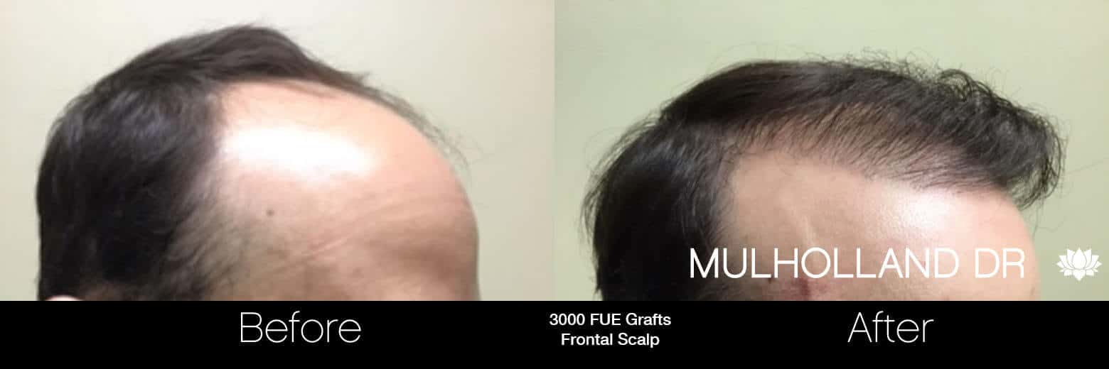 Artas Hair Transplant - Before and After Gallery - Patient Photo 59