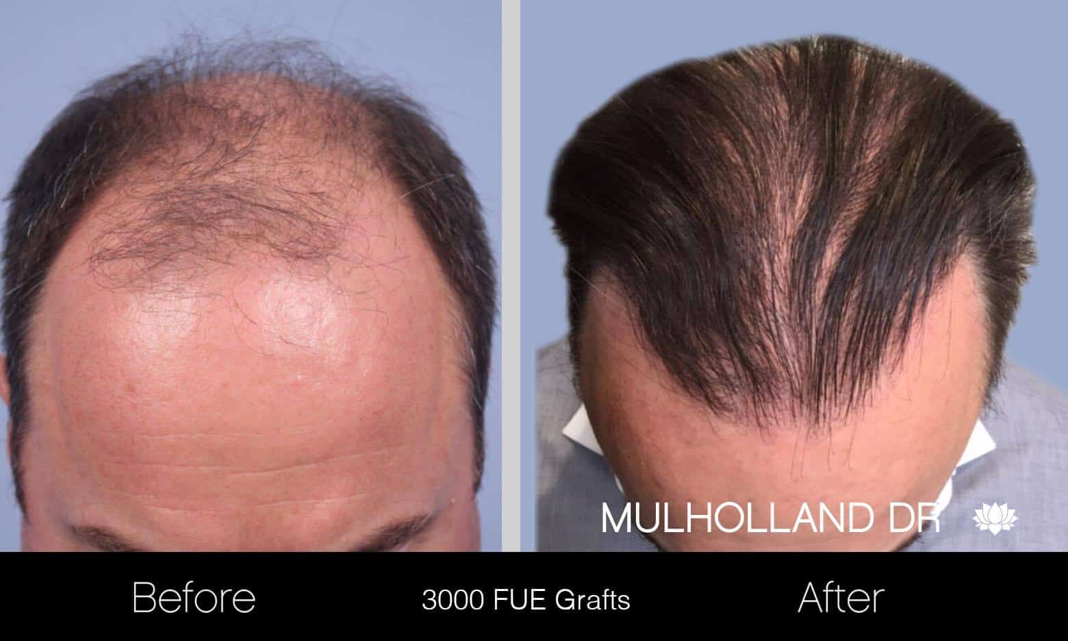 Artas Hair Transplant - Before and After Gallery - Patient Photo 6