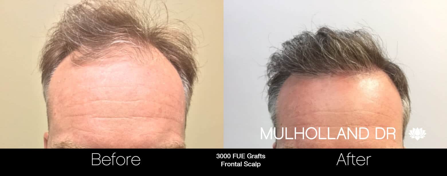 Artas Hair Transplant - Before and After Gallery - Patient Photo 60