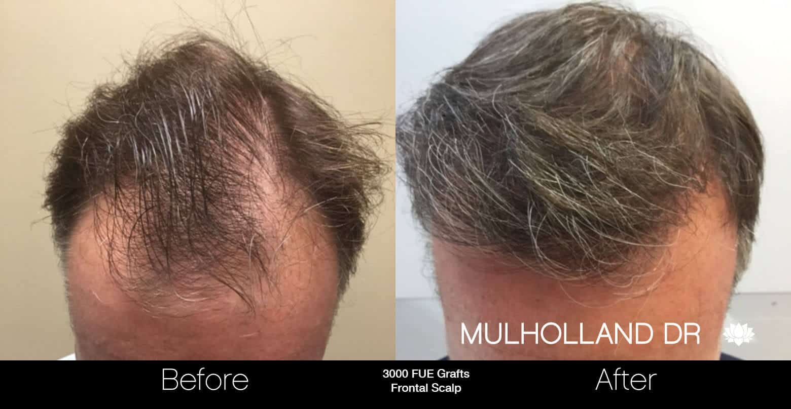 Artas Hair Transplant - Before and After Gallery - Patient Photo 61