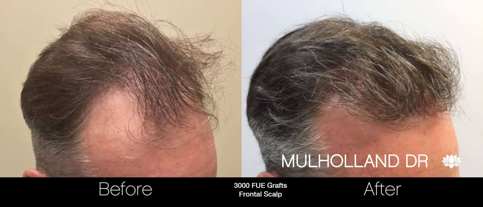 Artas Hair Transplant - Before and After Gallery - Patient Photo 63