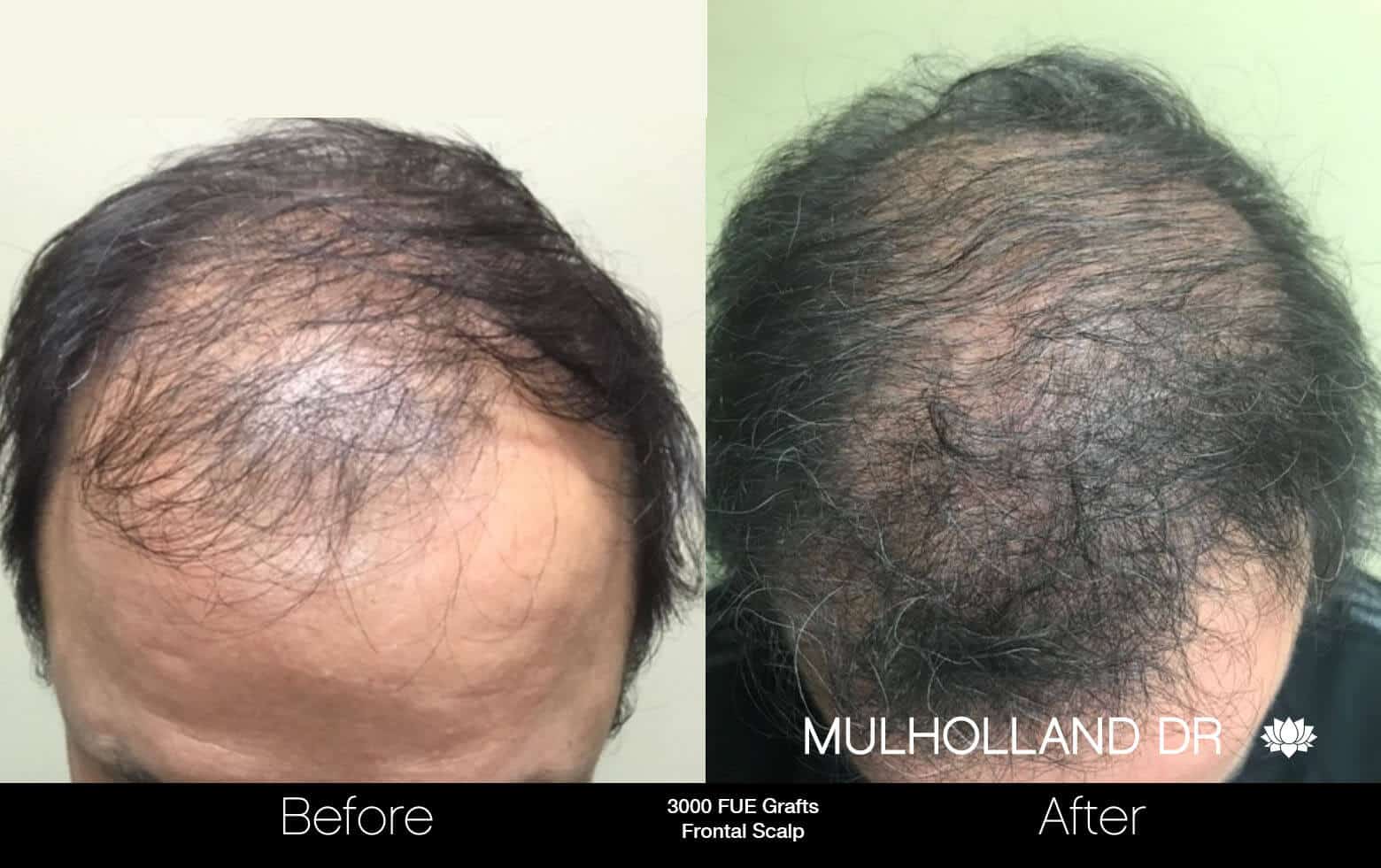 Artas Hair Transplant - Before and After Gallery - Patient Photo 64