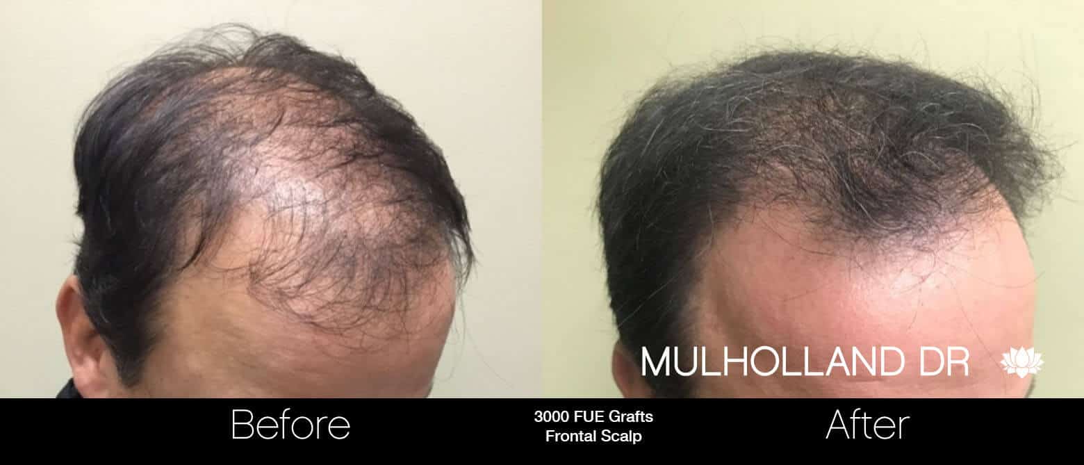 Artas Hair Transplant - Before and After Gallery - Patient Photo 65