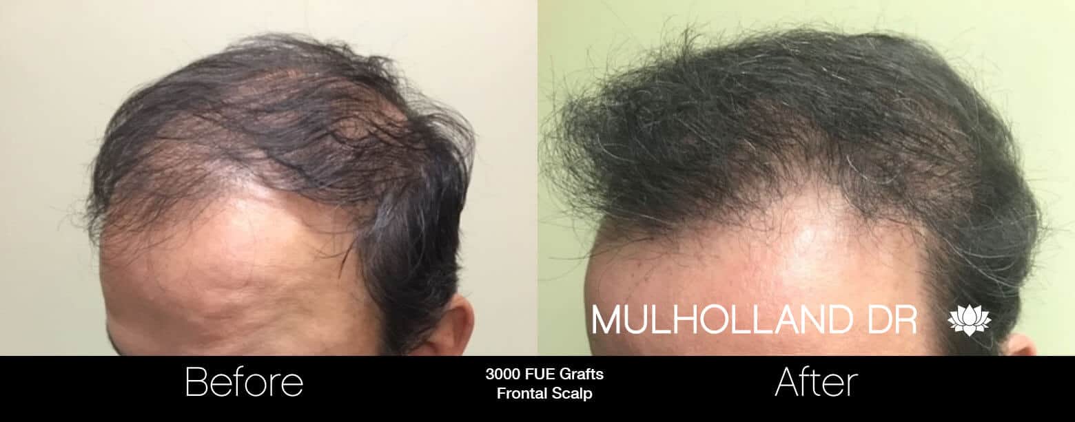Artas Hair Transplant - Before and After Gallery - Patient Photo 66