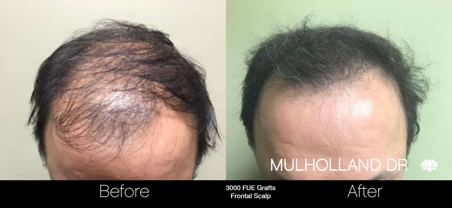 Artas Hair Transplant - Before and After Gallery - Patient Photo 67
