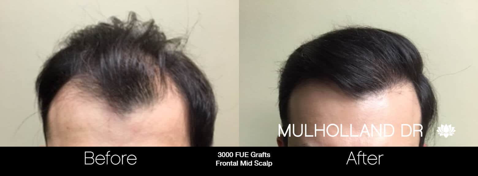 Artas Hair Transplant - Before and After Gallery - Patient Photo 68