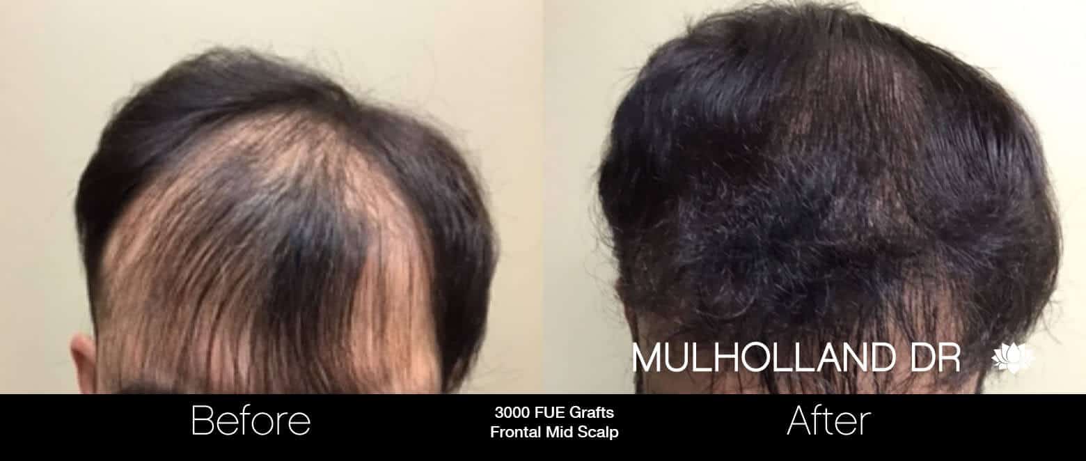 Artas Hair Transplant - Before and After Gallery - Patient Photo 69