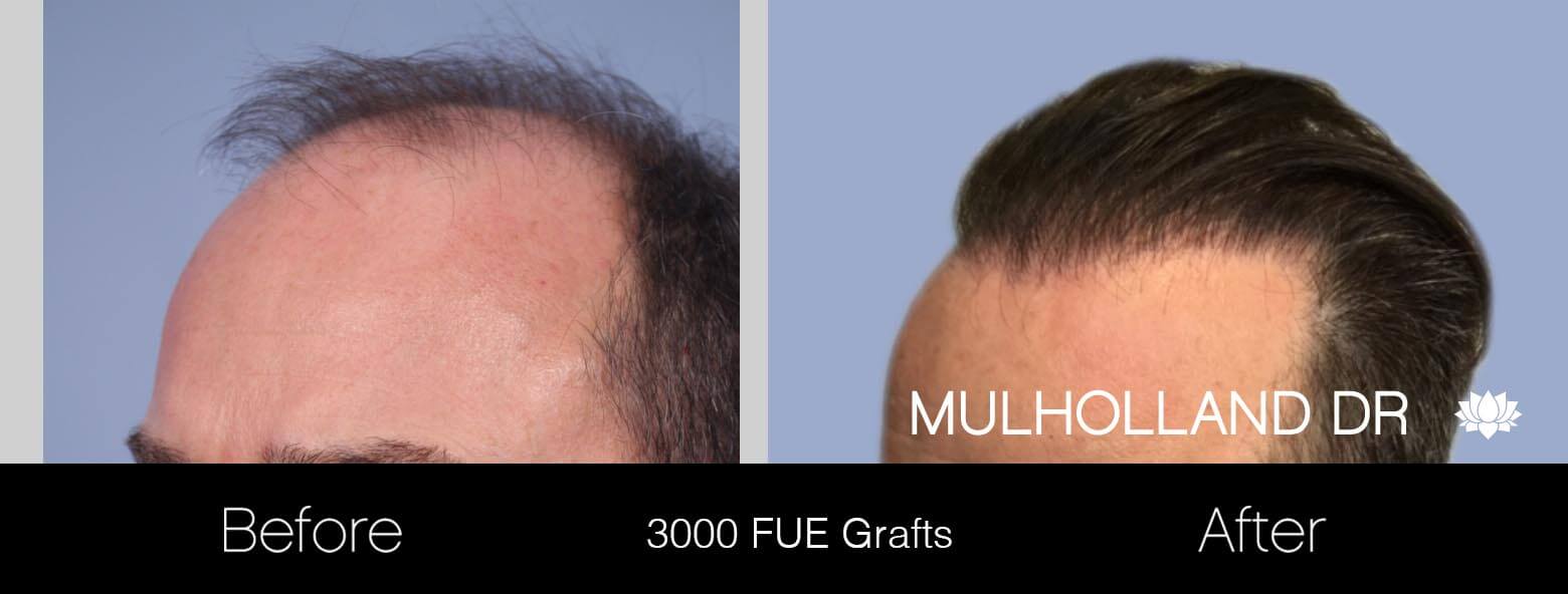 Artas Hair Transplant - Before and After Gallery - Patient Photo 7