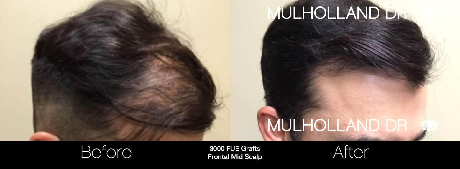 Artas Hair Transplant - Before and After Gallery - Patient Photo 71