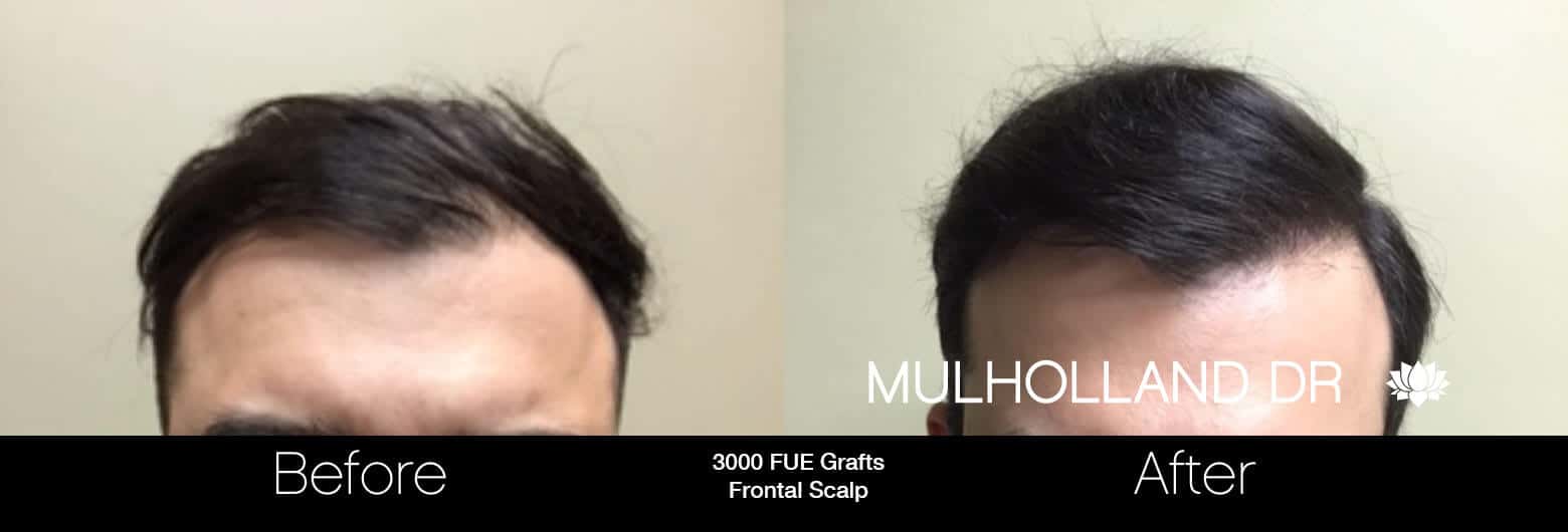 Artas Hair Transplant - Before and After Gallery - Patient Photo 73