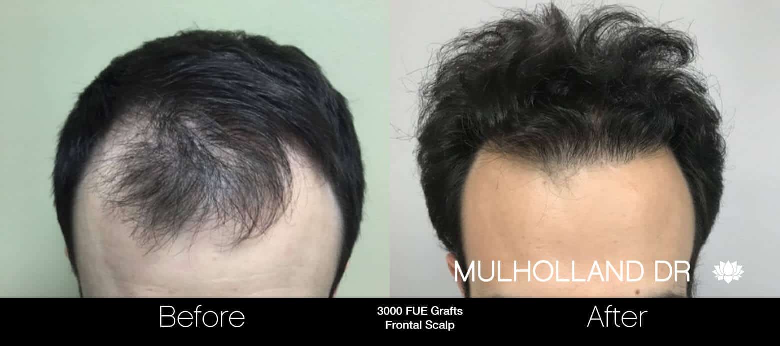 Artas Hair Transplant - Before and After Gallery - Patient Photo 74