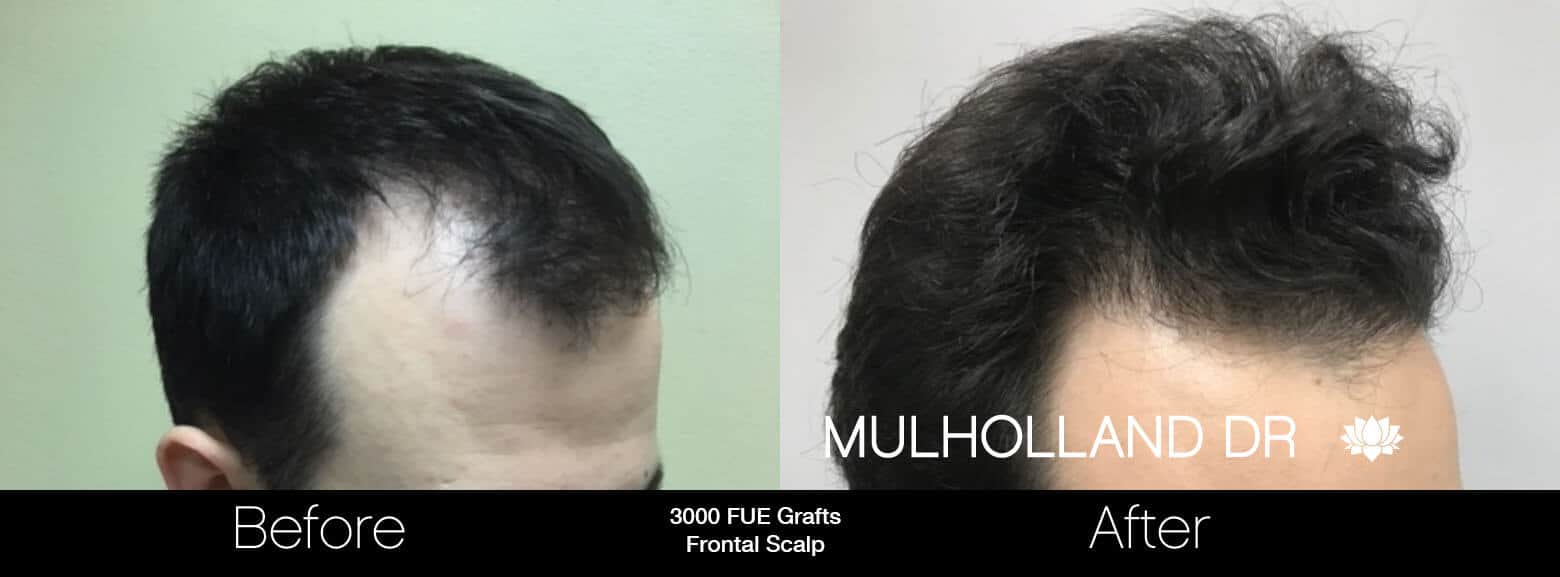 Artas Hair Transplant - Before and After Gallery - Patient Photo 75