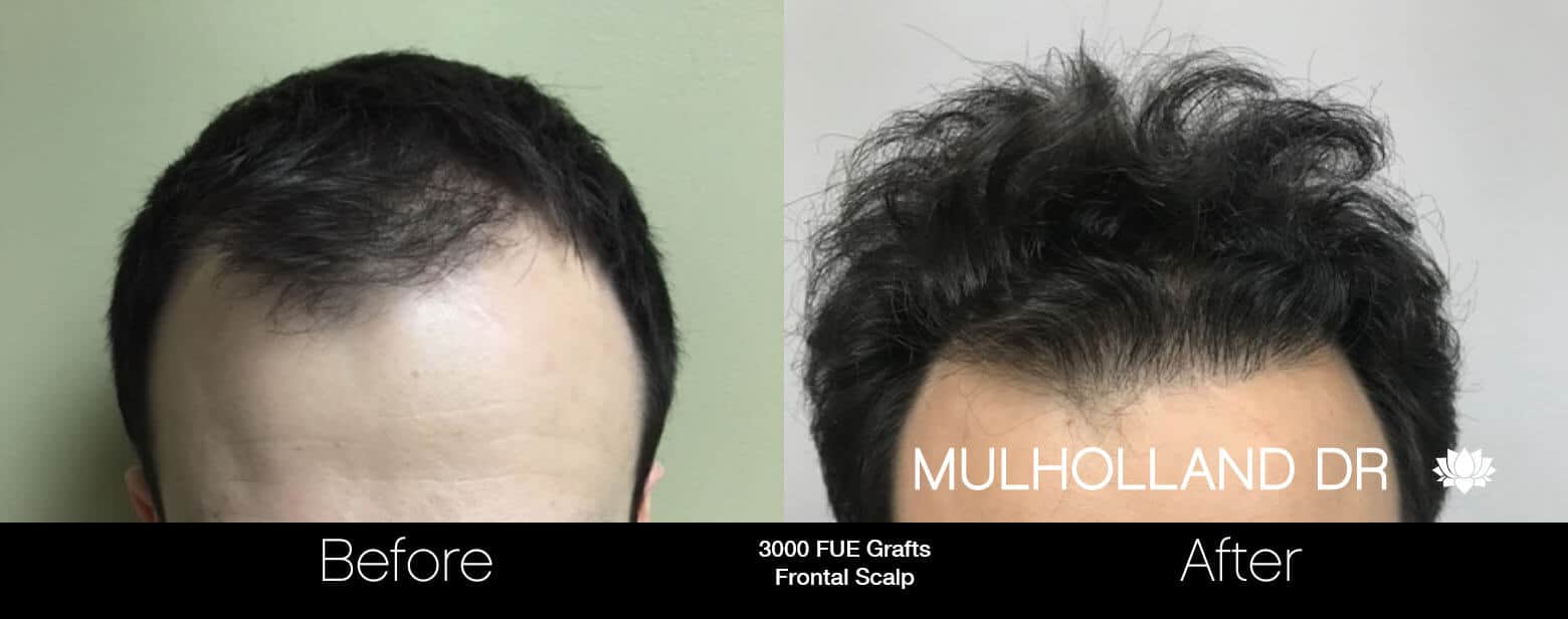 Artas Hair Transplant - Before and After Gallery - Patient Photo 76