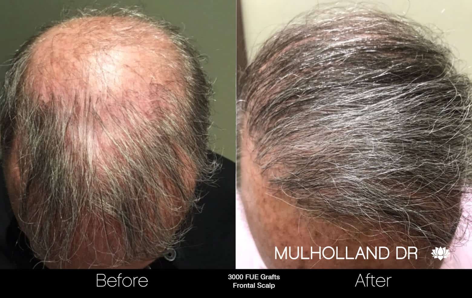 Artas Hair Transplant - Before and After Gallery - Patient Photo 77