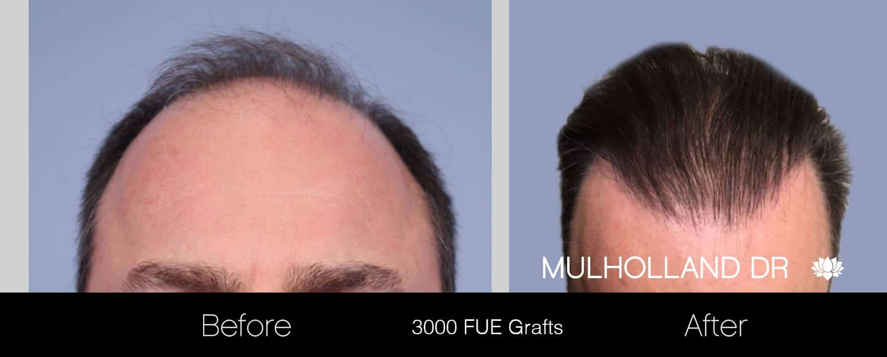 Artas Hair Transplant - Before and After Gallery - Patient Photo 8