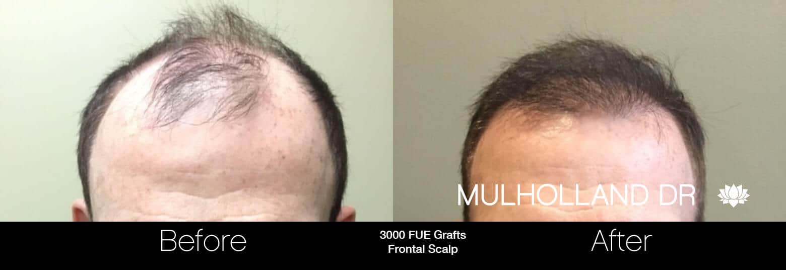Artas Hair Transplant - Before and After Gallery - Patient Photo 80