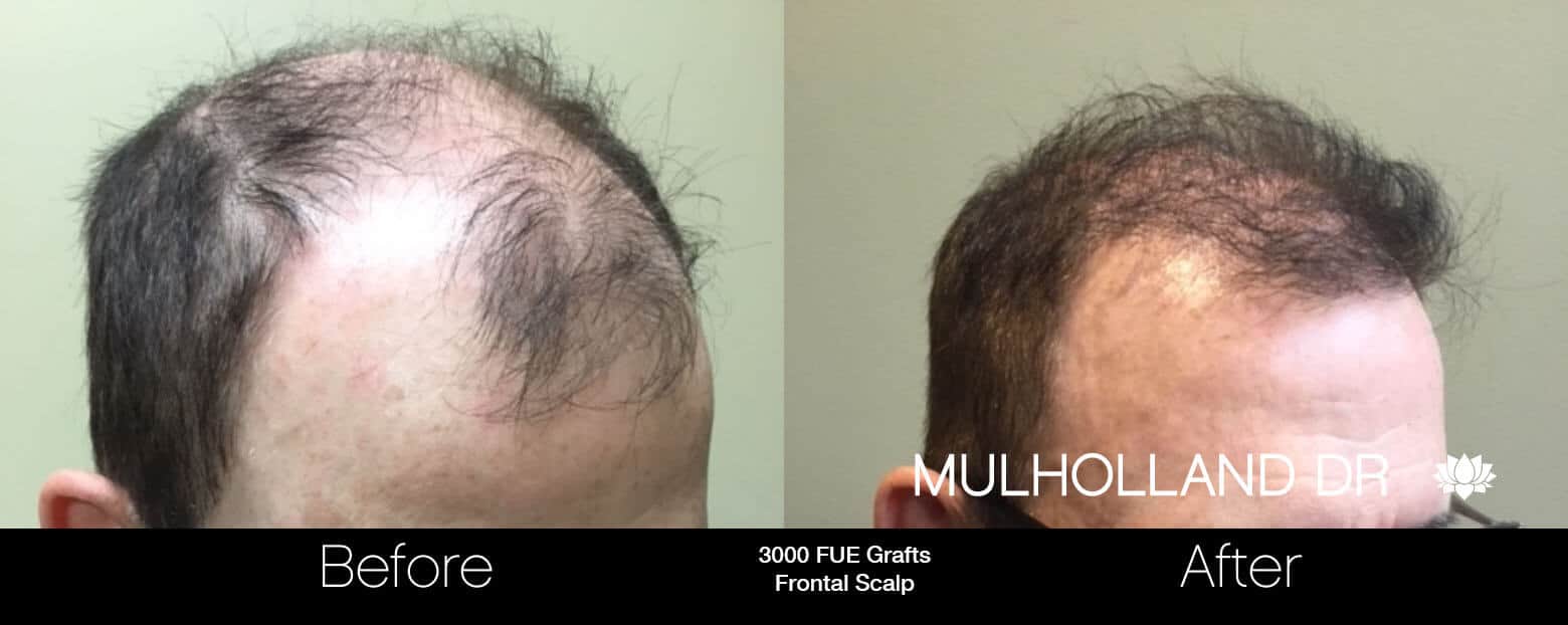 Artas Hair Transplant - Before and After Gallery - Patient Photo 83
