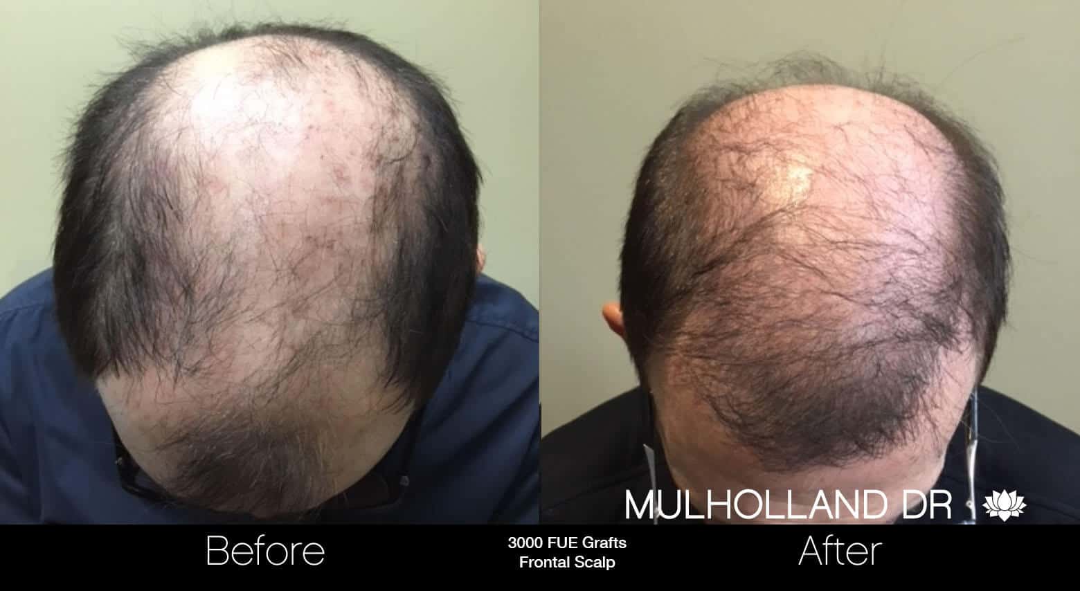 Artas Hair Transplant - Before and After Gallery - Patient Photo 84