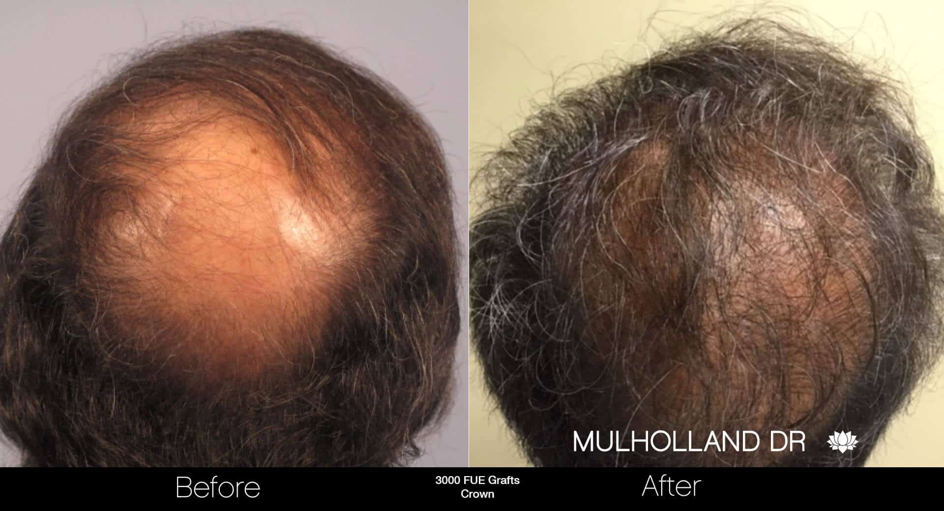 Artas Hair Transplant - Before and After Gallery - Patient Photo 85