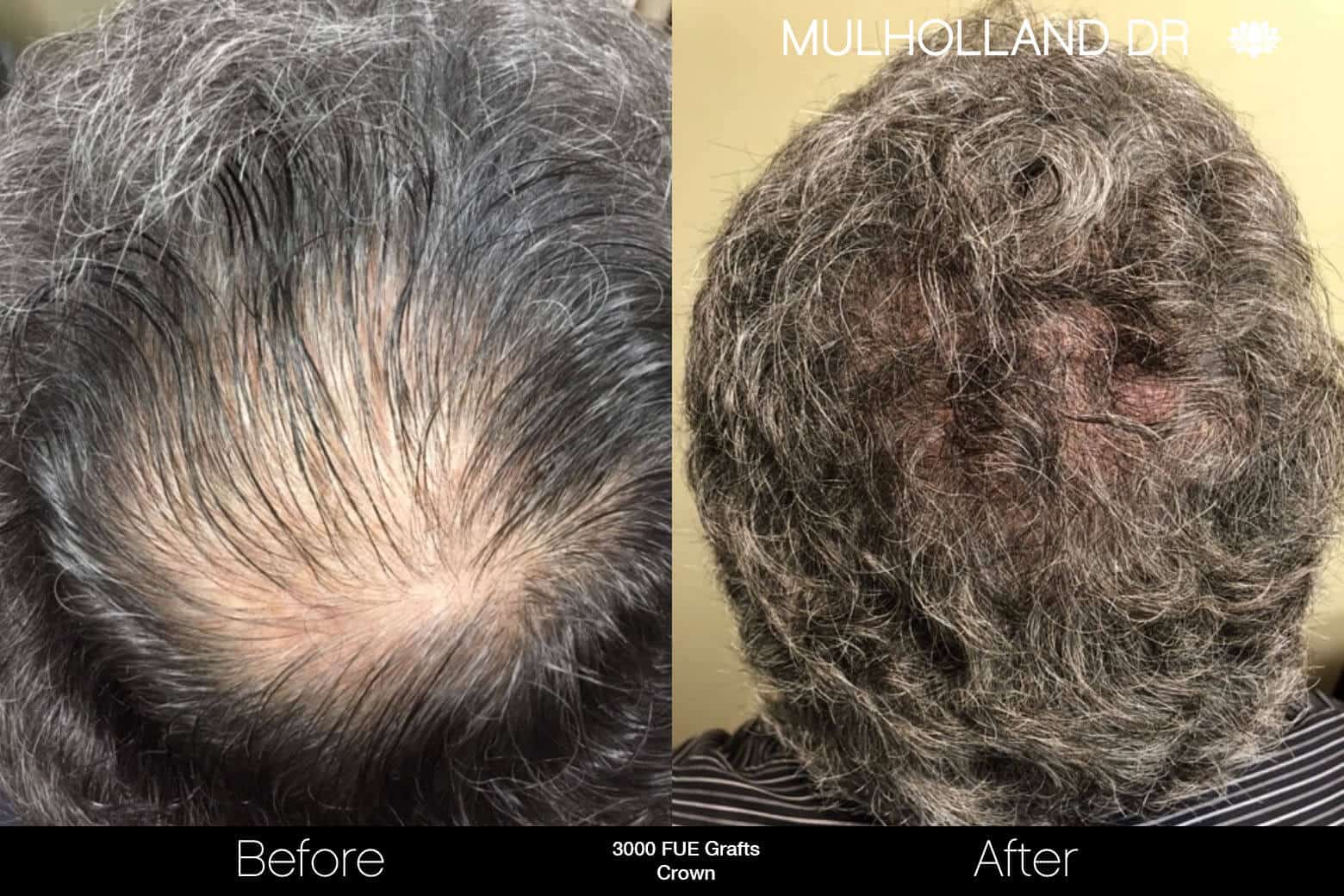 Artas Hair Transplant - Before and After Gallery - Patient Photo 87