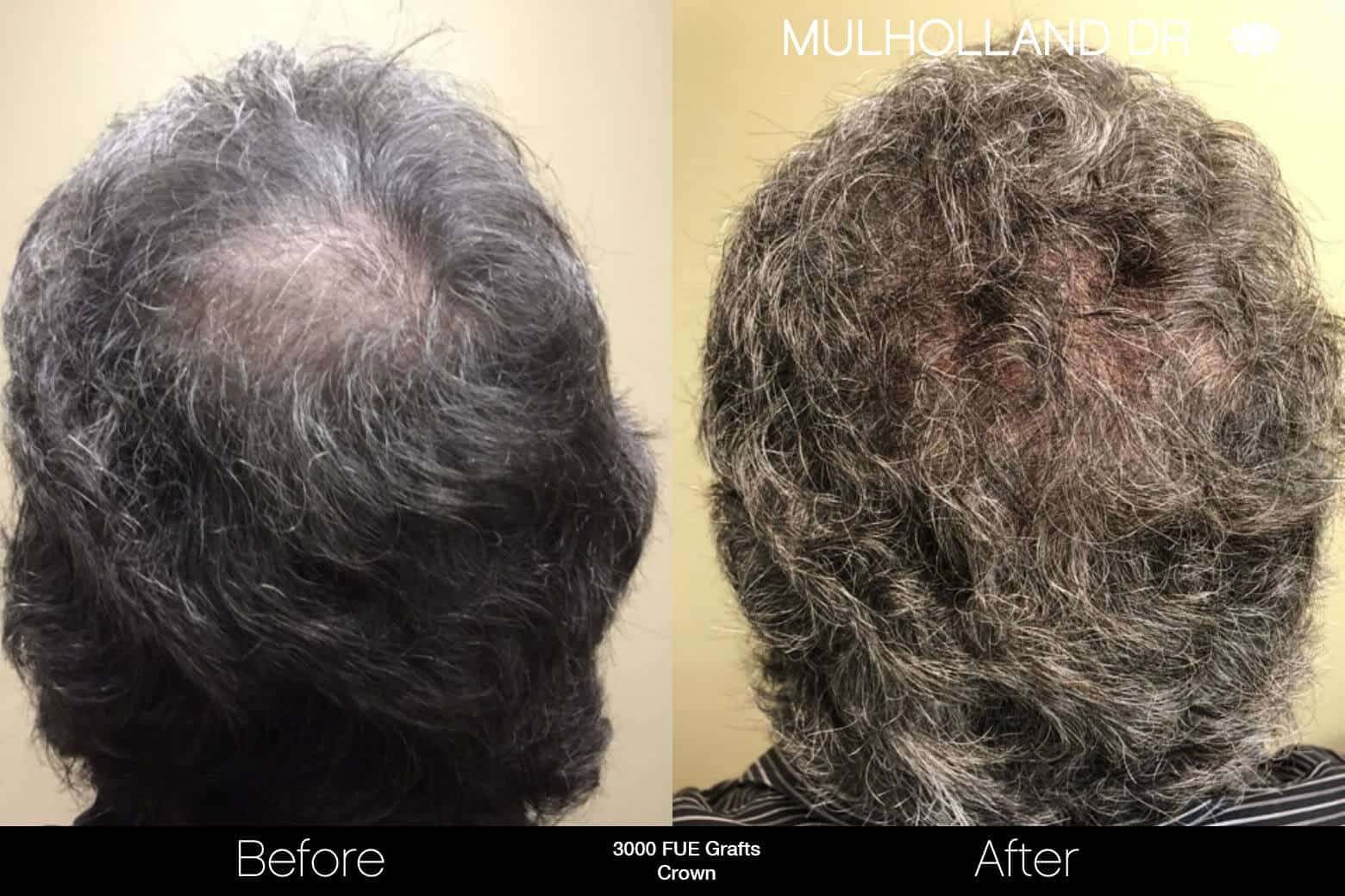 Artas Hair Transplant - Before and After Gallery - Patient Photo 88