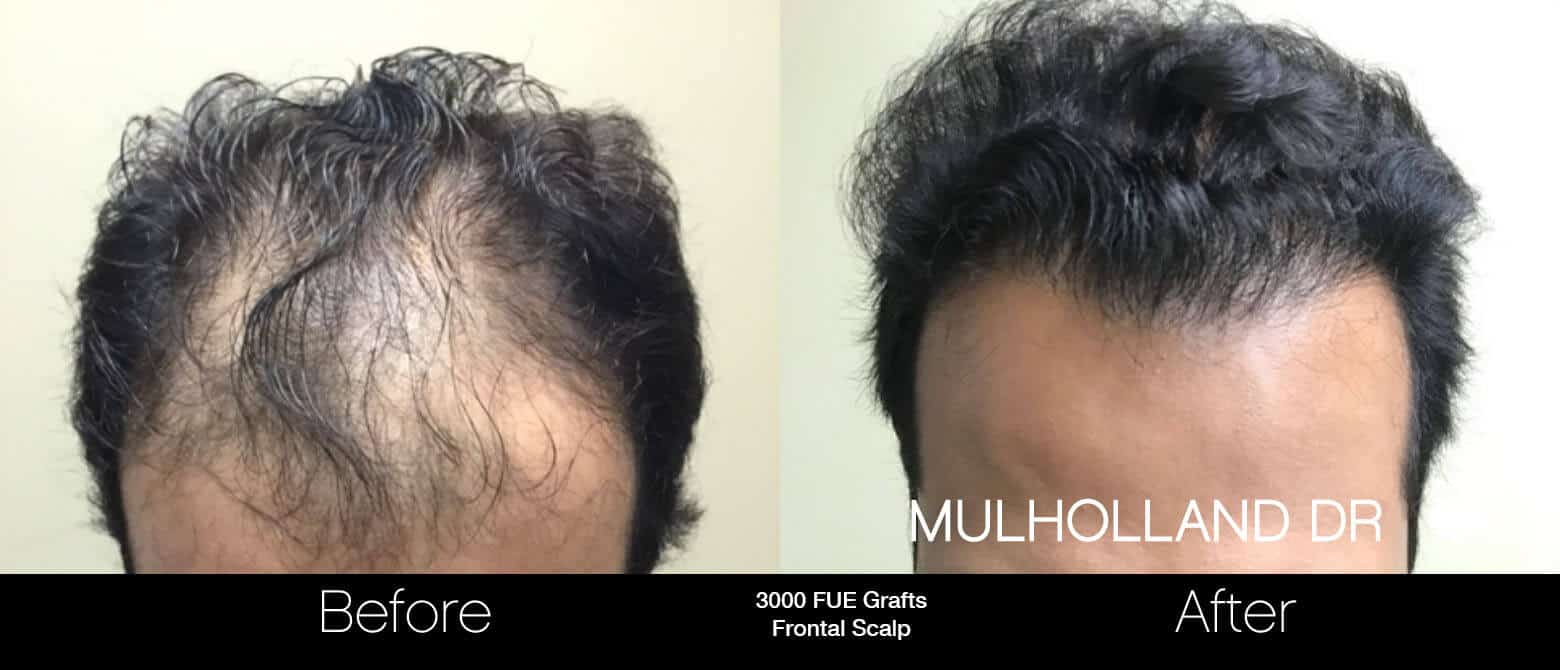 Artas Hair Transplant - Before and After Gallery - Patient Photo 9