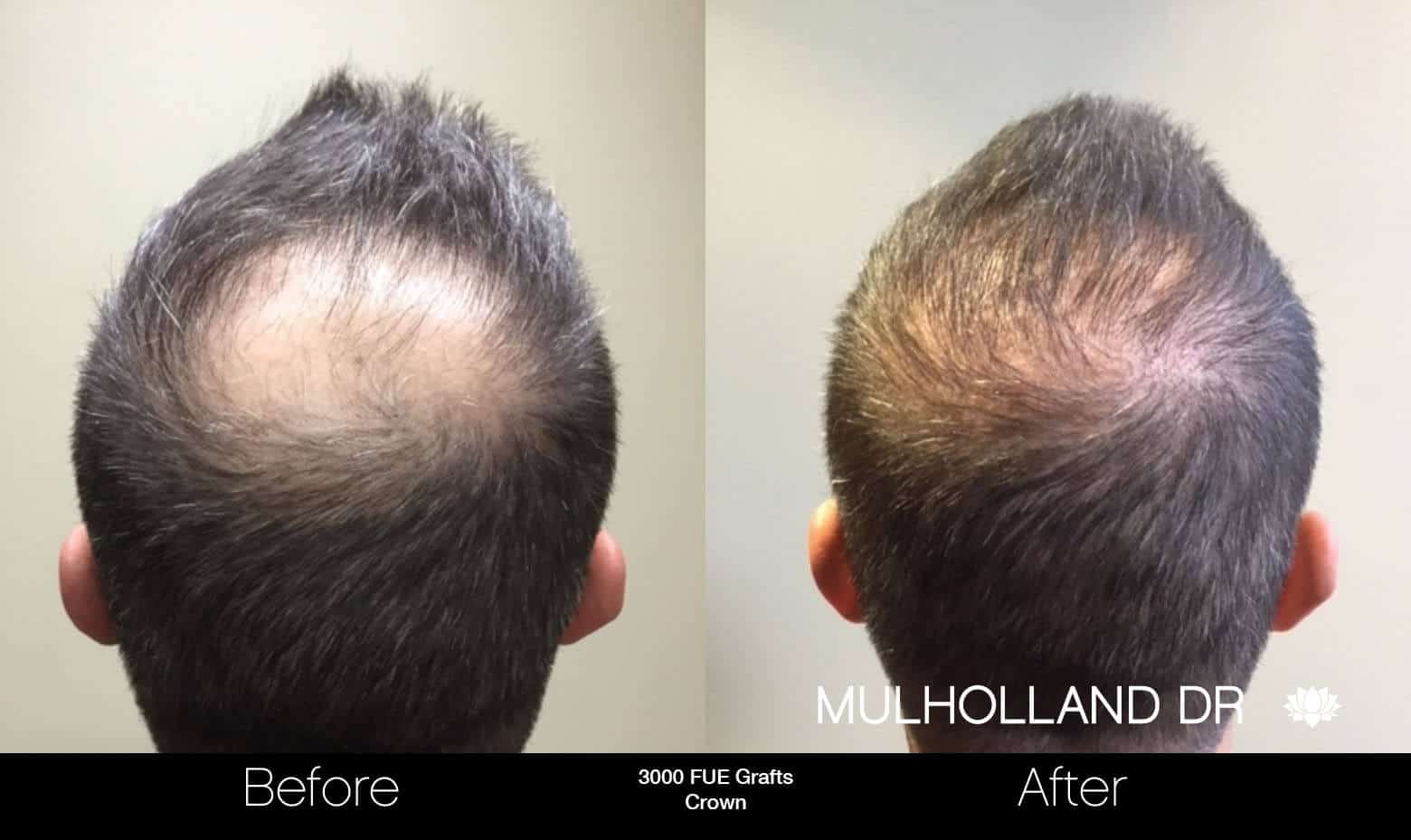 Artas Hair Transplant - Before and After Gallery - Patient Photo 92
