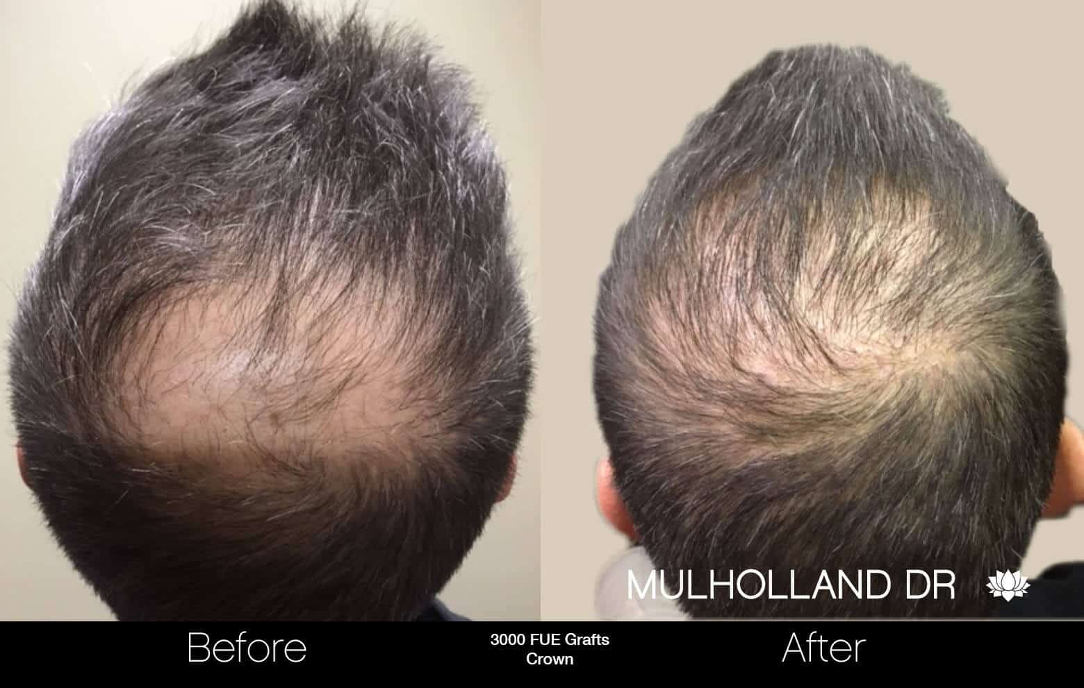 Artas Hair Transplant - Before and After Gallery - Patient Photo 93