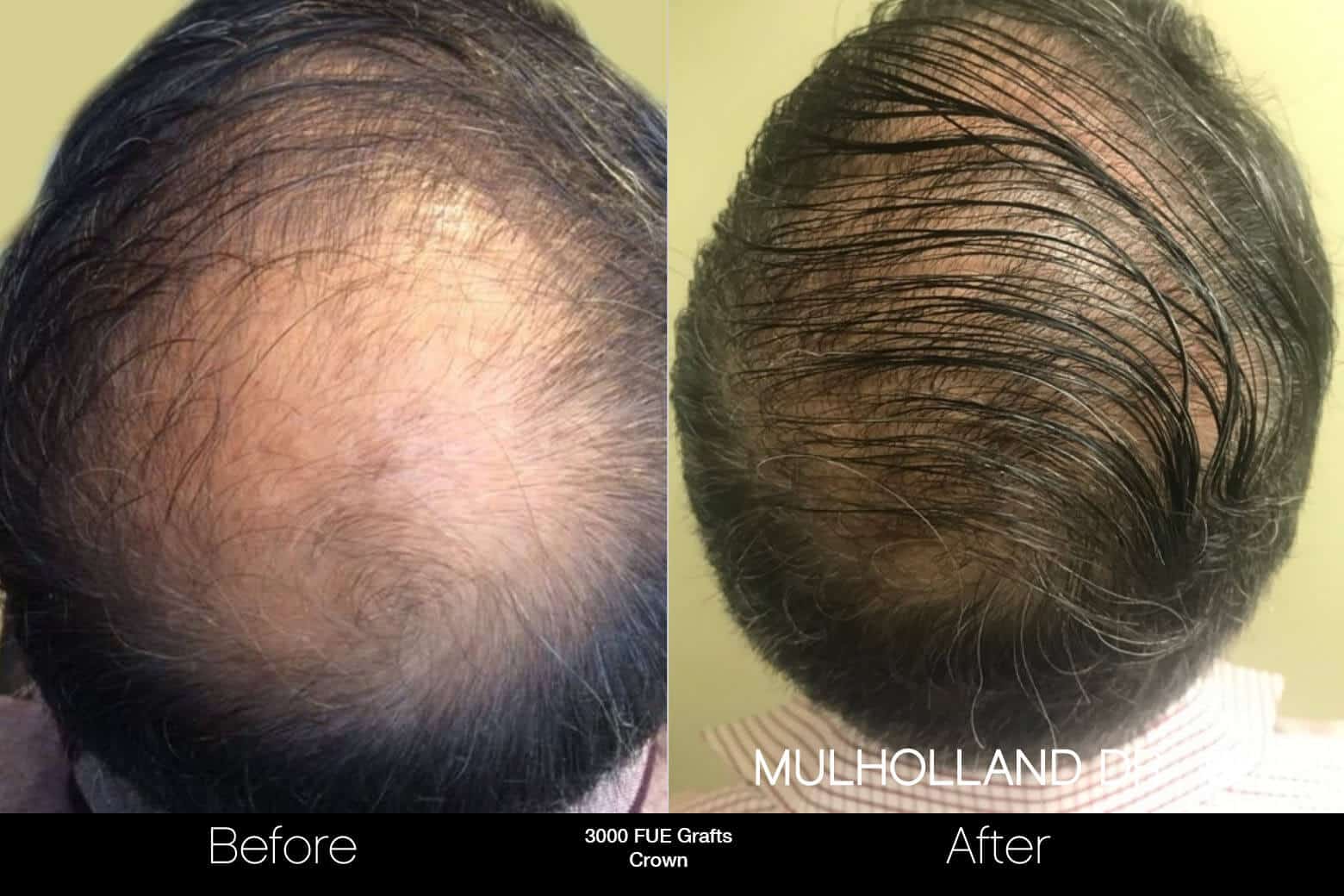 Artas Hair Transplant - Before and After Gallery - Patient Photo 95