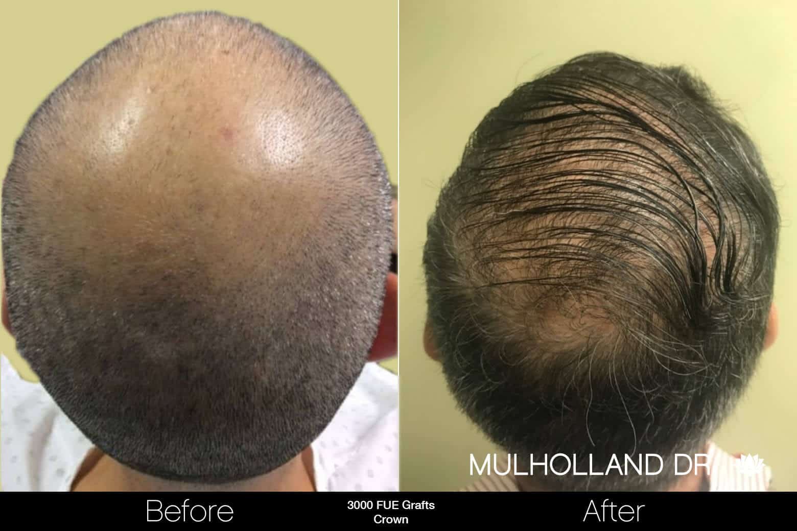 Artas Hair Transplant - Before and After Gallery - Patient Photo 96