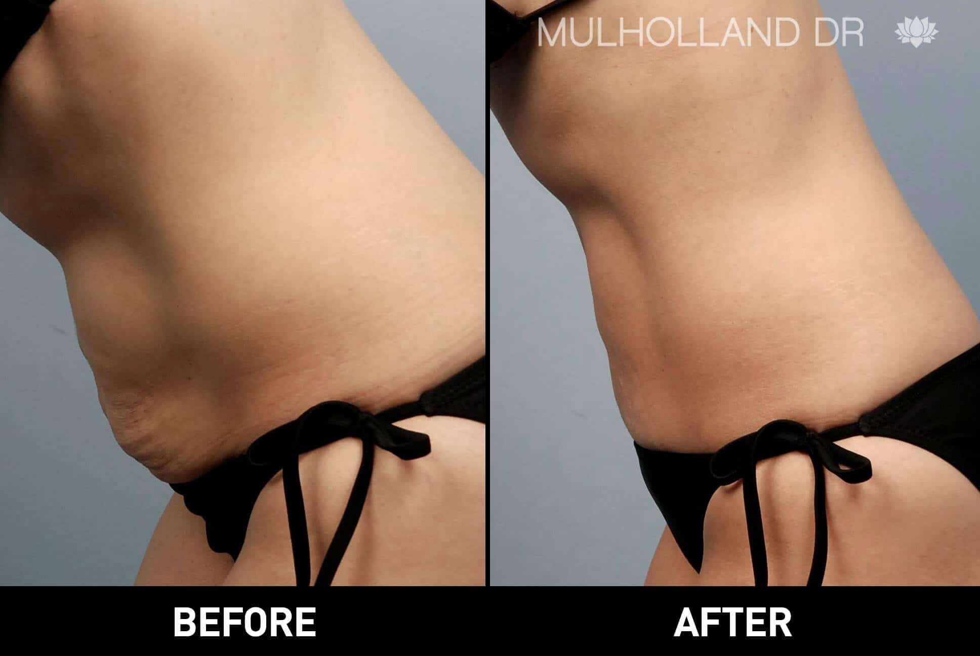 BodyTite Liposuction - Before and After Gallery - Patient Photo 10