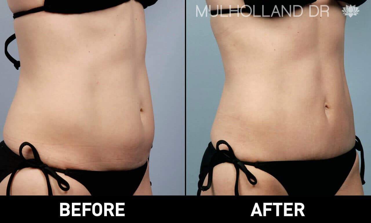 BodyTite Liposuction - Before and After Gallery - Patient Photo 11