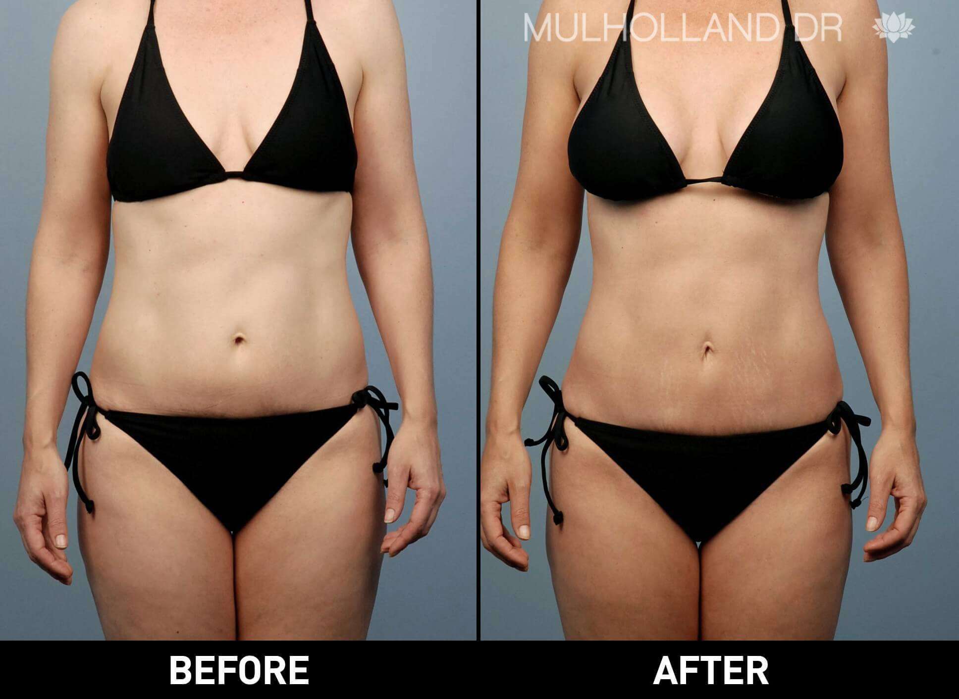 BodyTite Liposuction - Before and After Gallery - Patient Photo 13