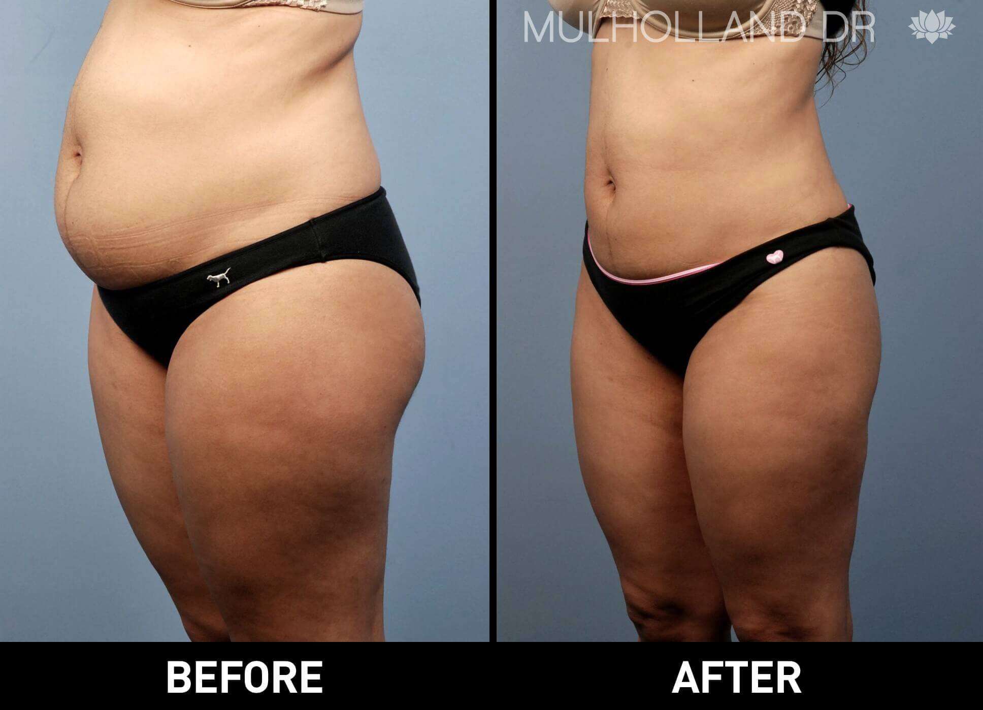BodyTite Liposuction - Before and After Gallery - Patient Photo 14