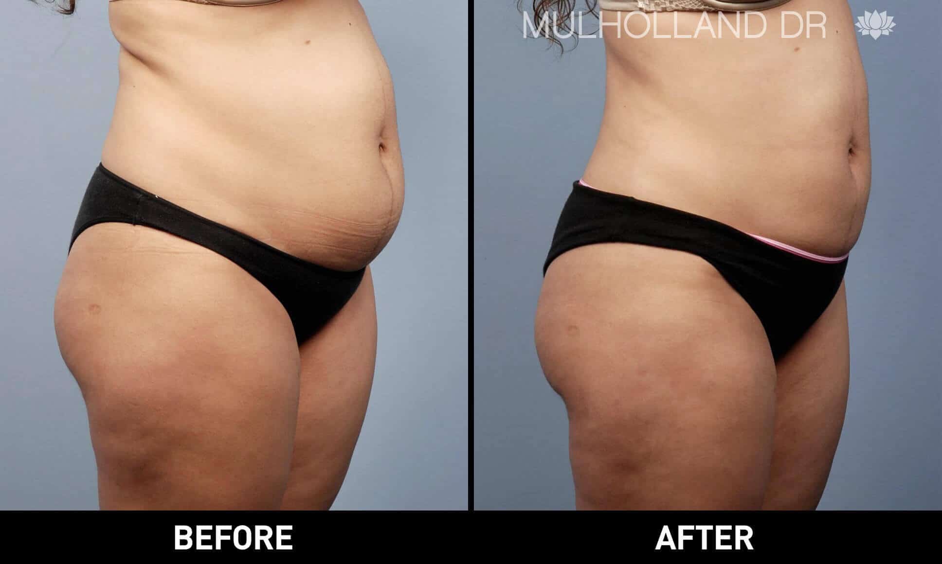 BodyTite Liposuction - Before and After Gallery - Patient Photo 15