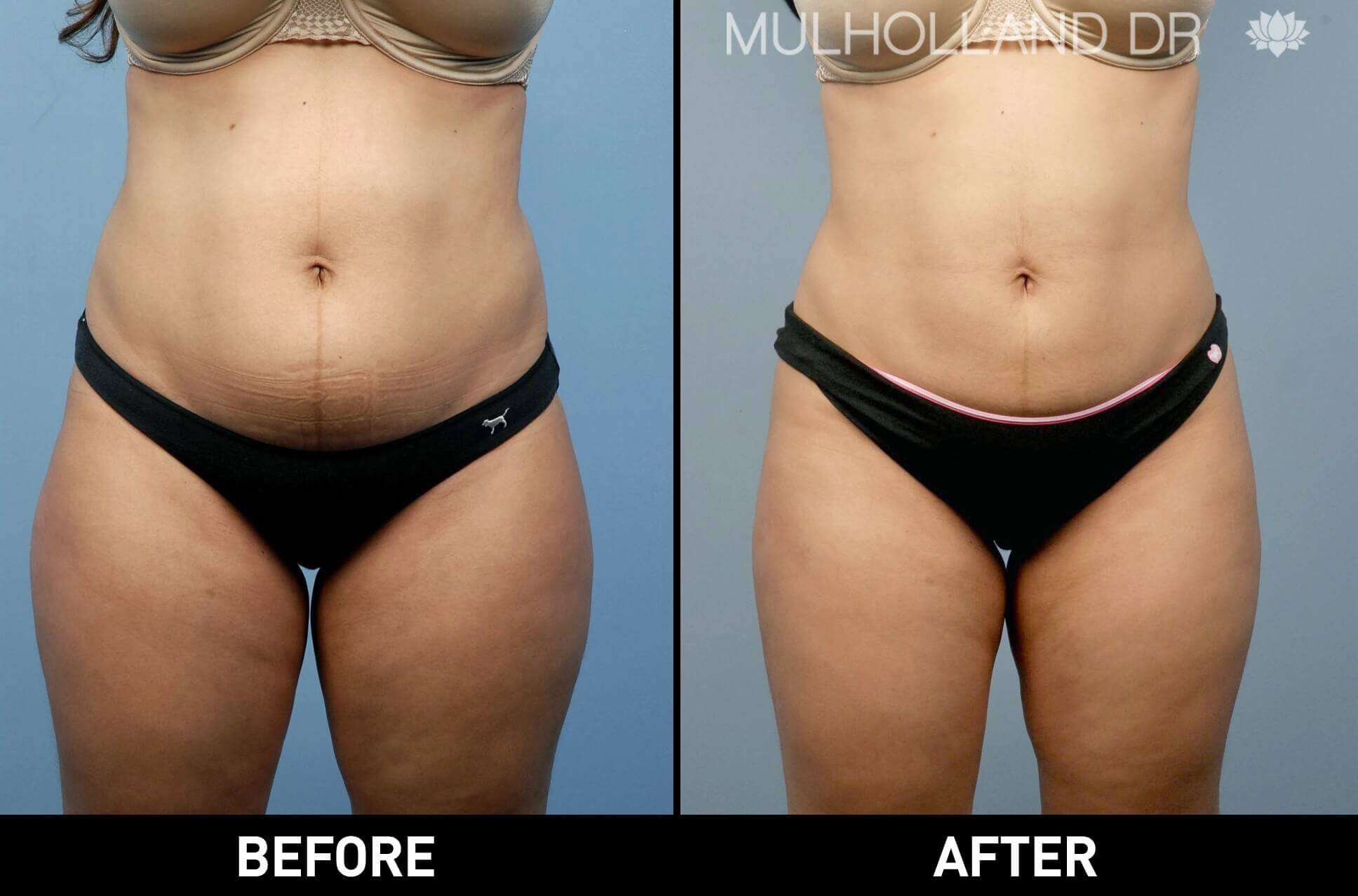 BodyTite Liposuction - Before and After Gallery - Patient Photo 17